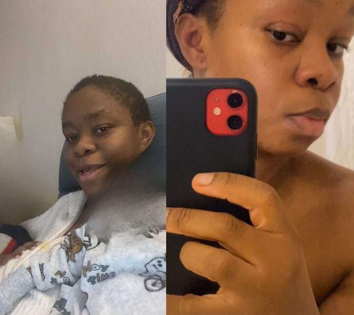 🌟 Comment éliminer l’hyperpigmentation et retrouver une peau éclatante quand on a la peau noire, foncée ou métissée ?